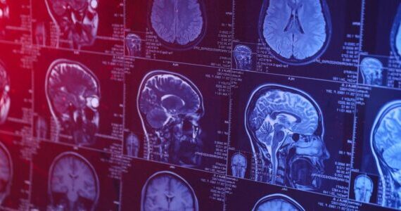 New brain scanning method safely tracks how Alzheimer’s drugs work in living patients