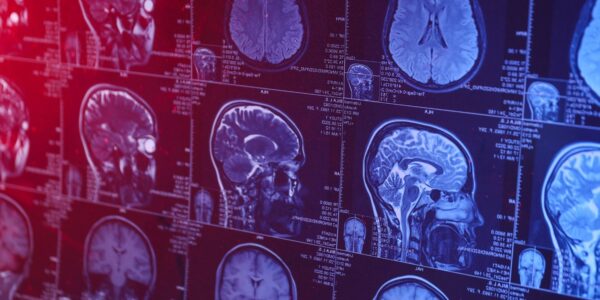 New brain scanning method safely tracks how Alzheimer’s drugs work in living patients