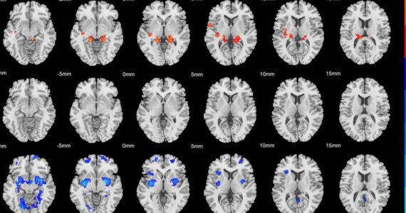 Brain scans reveal two distinct physical subtypes of ADHD
