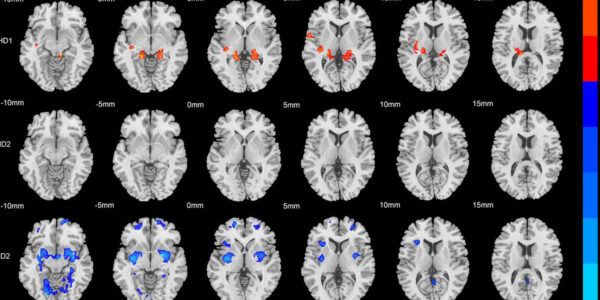 Brain scans reveal two distinct physical subtypes of ADHD