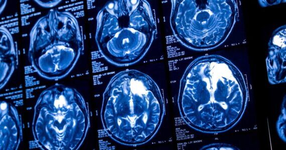 Growing up in a disadvantaged neighborhood is associated with faster brain maturation