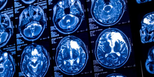 Growing up in a disadvantaged neighborhood is associated with faster brain maturation
