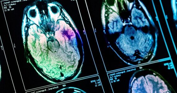 Breathing polluted air is linked to lagging brain and cognitive growth in young teenagers