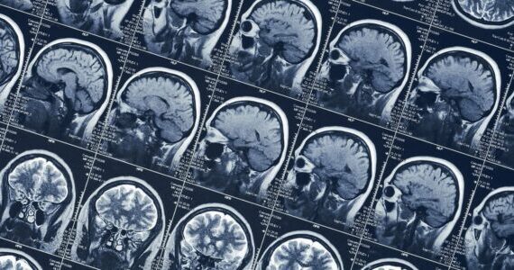 People working in shifts undergo gradual shrinkage of two brain regions